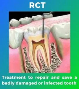 dental RCT