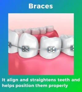 dental braces