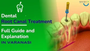 Read more about the article Best Dental Root Canal Treatment RCT in Varanasi: Full Guide & Explain