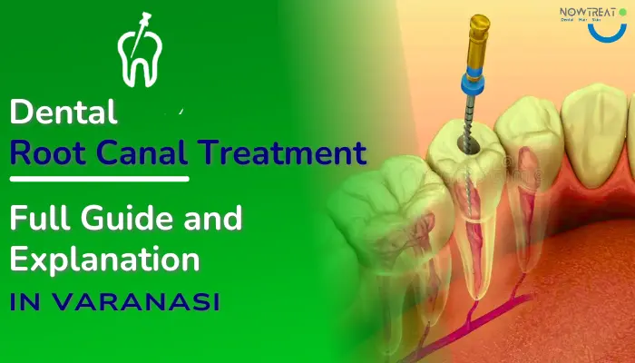 Best Dental Root Canal Treatment RCT in Varanasi: Full Guide & Explain You are currently viewing Best Dental Root Canal Treatment RCT in Varanasi: Full Guide & Explain