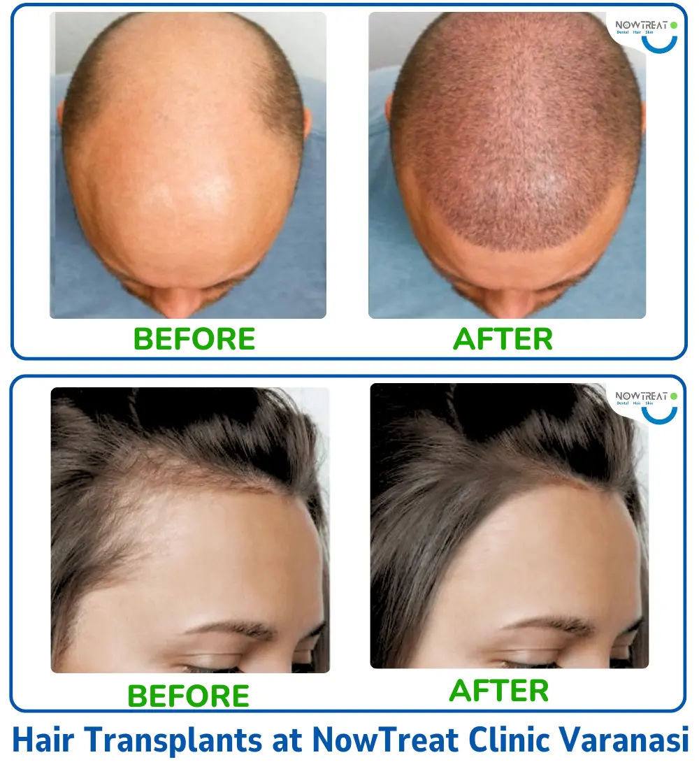 Hair Transplants Before After at NowTreat Clinic Varanasi