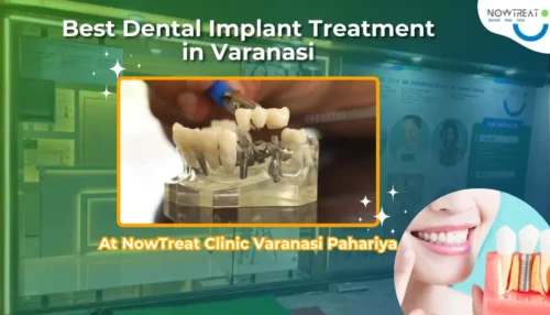 Read more about the article Best Dental Implant Treatment in Varanasi | NowTreat Clinic