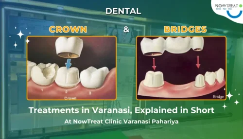 Read more about the article Best Dental Crowns and Bridges Treatment in Varanasi