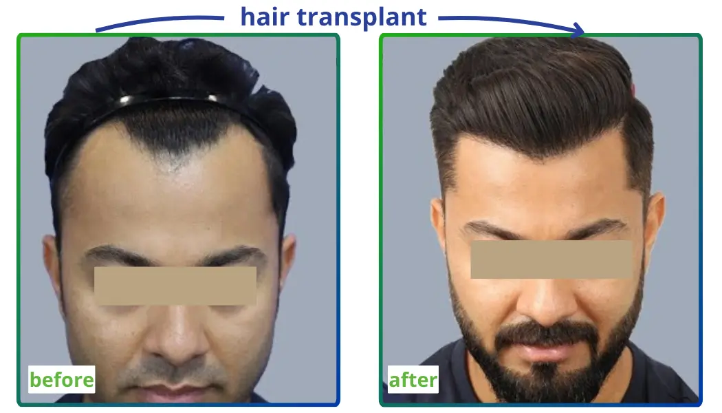 Top Hair Transplant in Varanasi with Hair Restoration Doctor Hair Transplant Results two photos Before and After in Varanasi